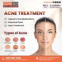 Best Advance Syringoma Treatment in india