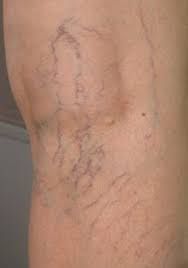 Texas Spider Vein Treatment Near Me