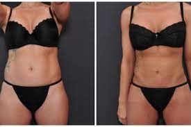 Vaser Hi Def Liposuction Houston TX