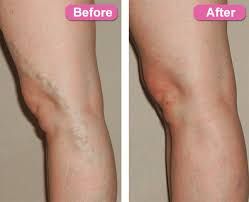 San Jose Spider Vein Treatment Near Me