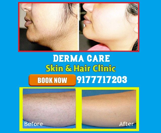Laser Hair Removal in Hyderabad | Permanent Hair Removal in Himayat Nagar