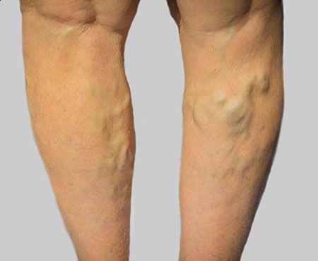 Laser Vein Removal Centers