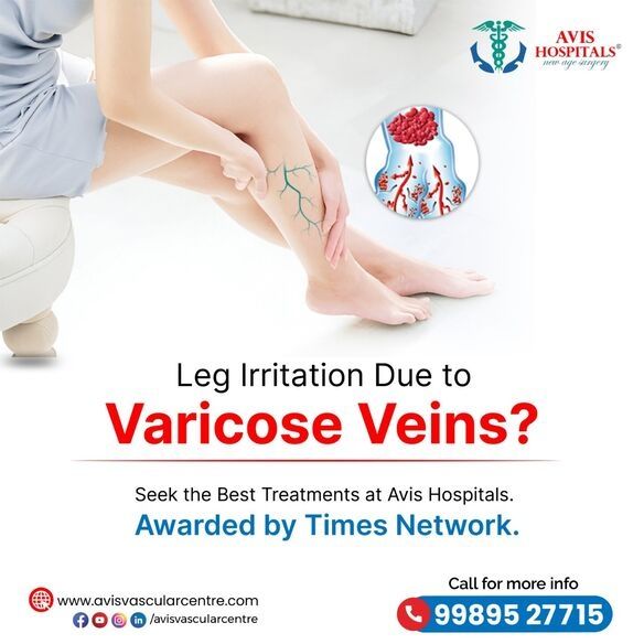 Best Varicose Veins Treatment in Hyderabad