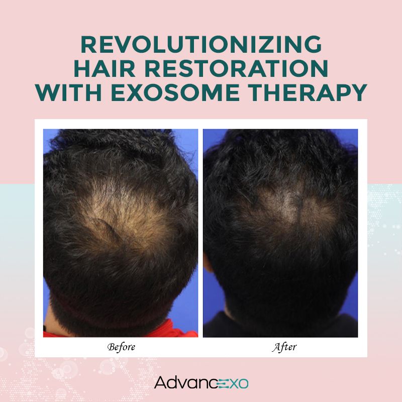 Revolutionizing Hair Restoration with Exosome Therapy