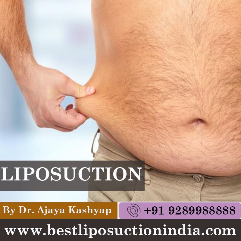 Best Liposuction Surgery Clinic in Delhi