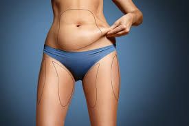 Liposuction Surgery in Gurgaon