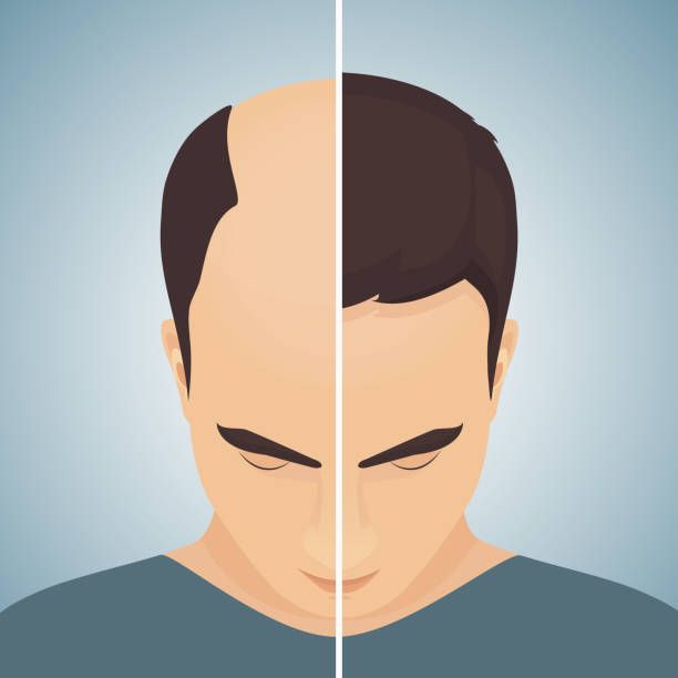 Leading Hair Transplant in London