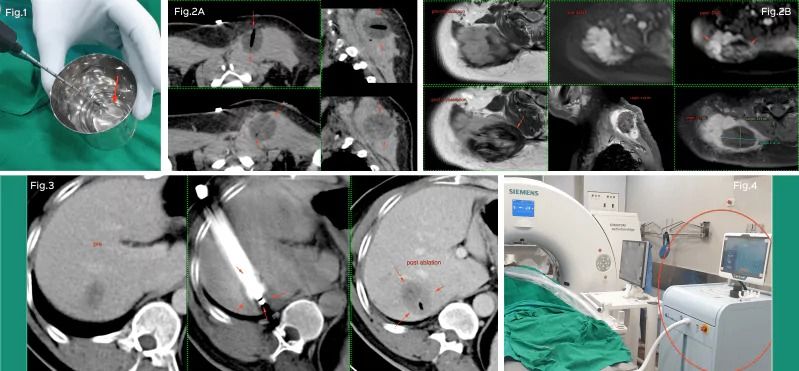 Discover Advanced Cryoablation Treatment Options with Picture This 
