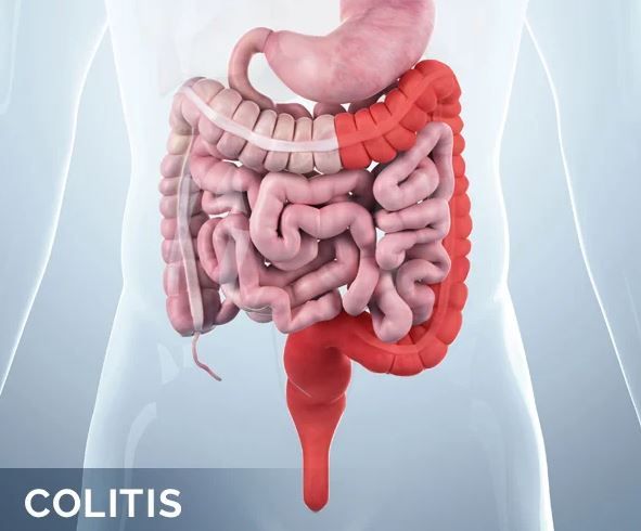 Ulcerative Colitis