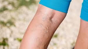 What Causes Leg Heaviness?