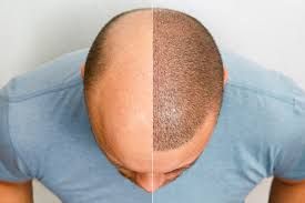 Hair transplantation in Riyadh