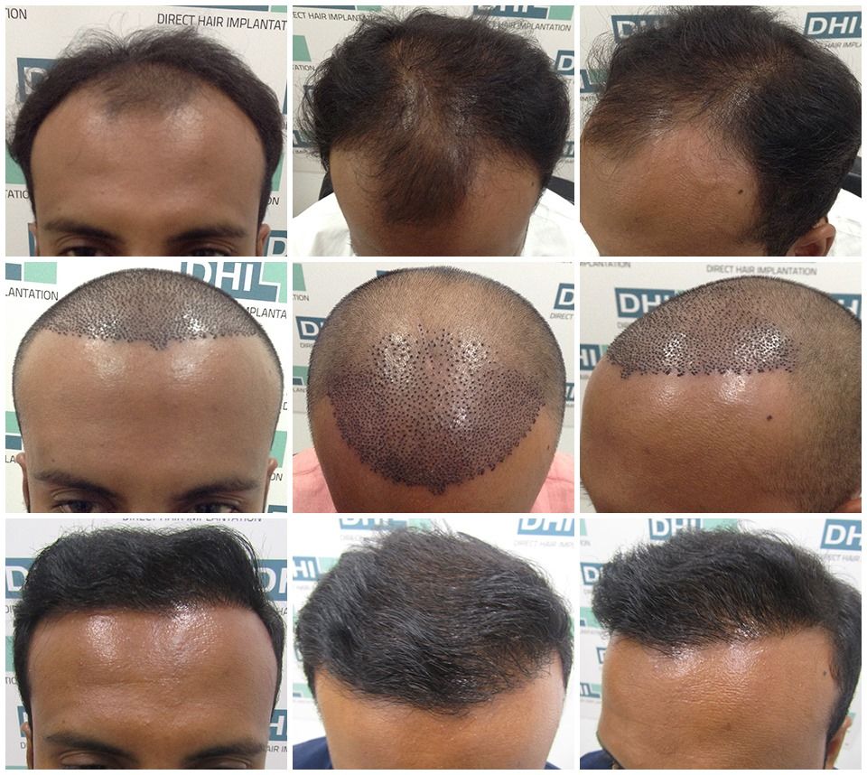 Best hair transplant clinic in Delhi | DHI India