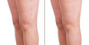 Vein Treatment Near Me