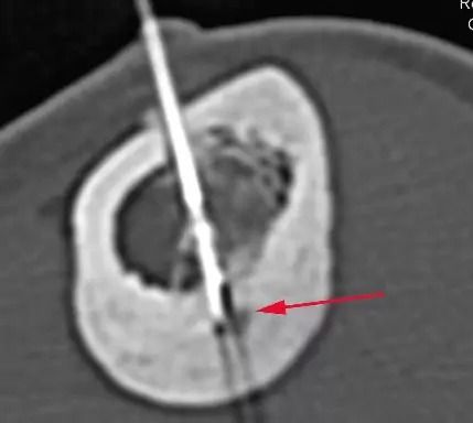Affordable RFA Cost in India for Pain Management - Picture This Imaging 