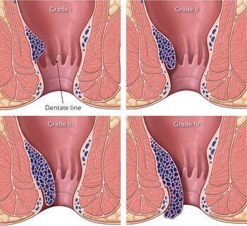 Piles doctor in Patna |Best piles, homeopathic  and fistula bawasir doctor and surgeon in Patna | bawasir surgeon in Patna