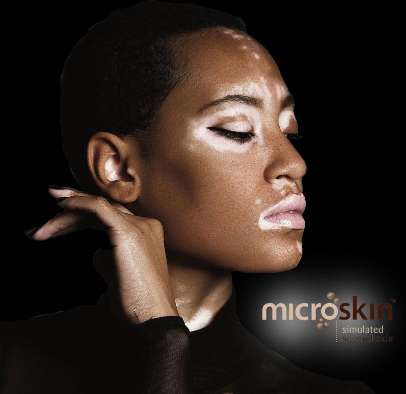 Vitiligo Leucoderma