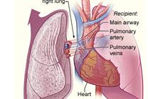 Lung transplantation in India | Transplant Counsellor 