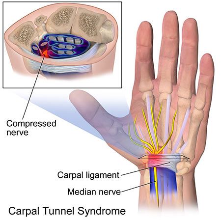 Wrist Pain Treatment in NYC