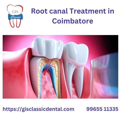 Root Canal Treatment in Coimbatore | Endodontist in Coimbatore