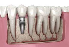 Dental Implants Near Me