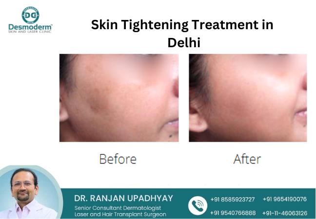 Advanced Skin Tightening Treatment in Delhi – Desmoderm