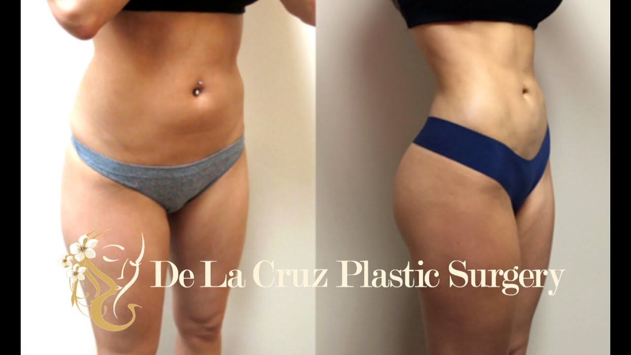 Neck Liposuction Surgeons in Houston