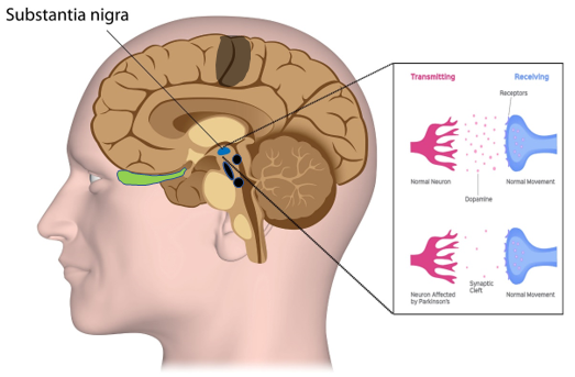 Best Doctor for Parkinson Disease