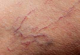 Vein Treatments Center in South Shore