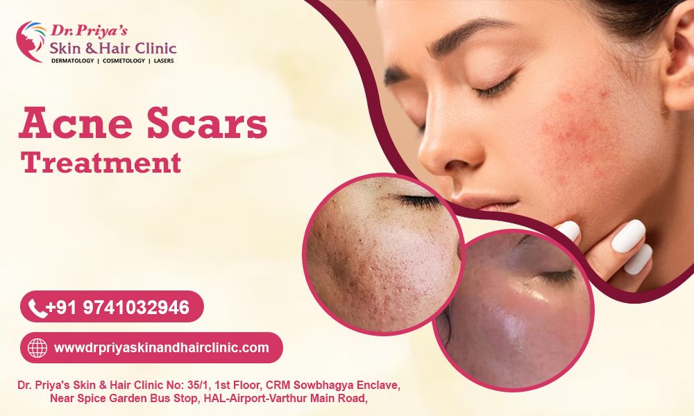 Effective Acne Scar Treatments in Bangalore - Dr. Priya Talageri