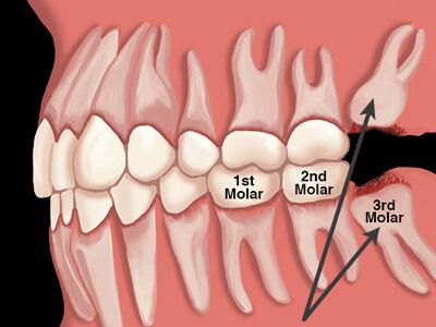 Best Wisdom Tooth Removal Service in Udaipur