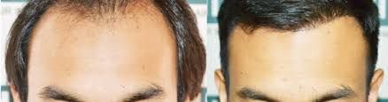 Regain Self Confidence By Choosing The Top Hair Transplant Clinic