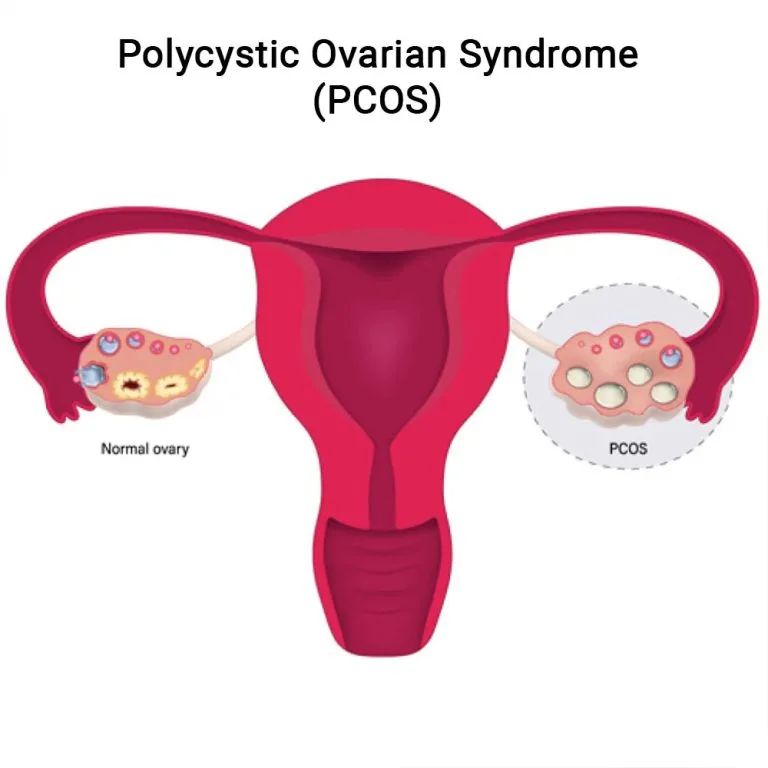 Polycystic Ovarian Syndrome (PCOS) Specialist  - NY