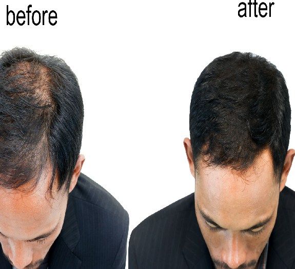 Get Advice And Treatment By Exploring Hair Transplant Price In Noida