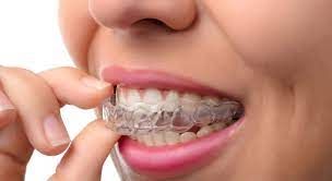 Braces Teeth Alignment Treatment