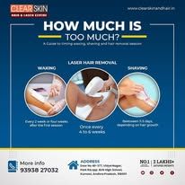 Birthmark removal treatment in india