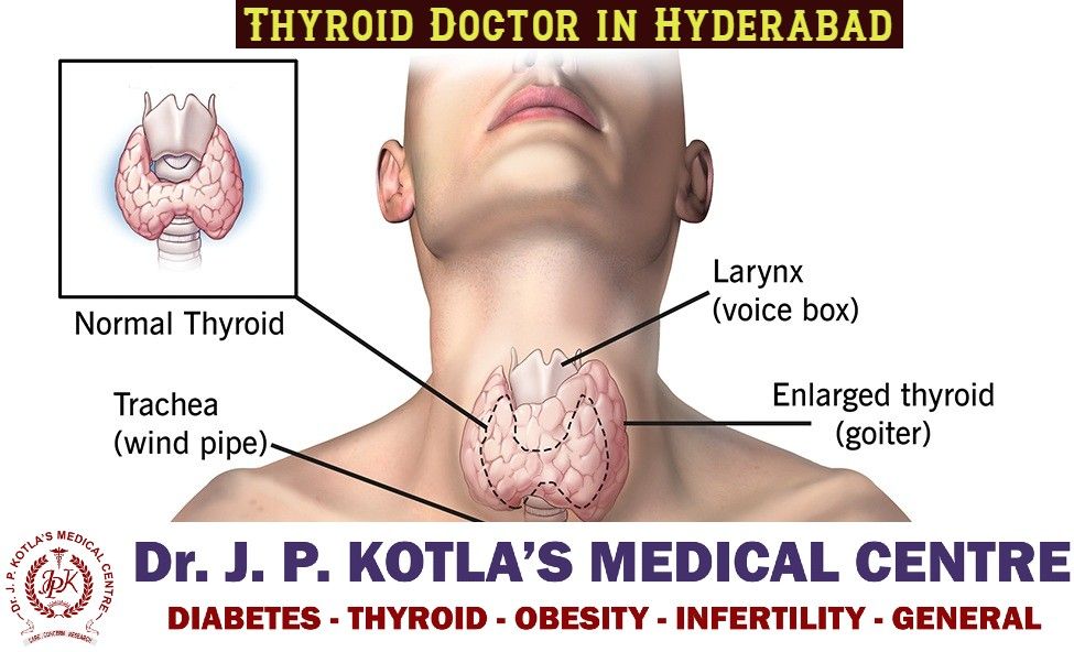 Thyroid Doctor in Himayat Nagar | Thyroid Specialist in Hyderabad