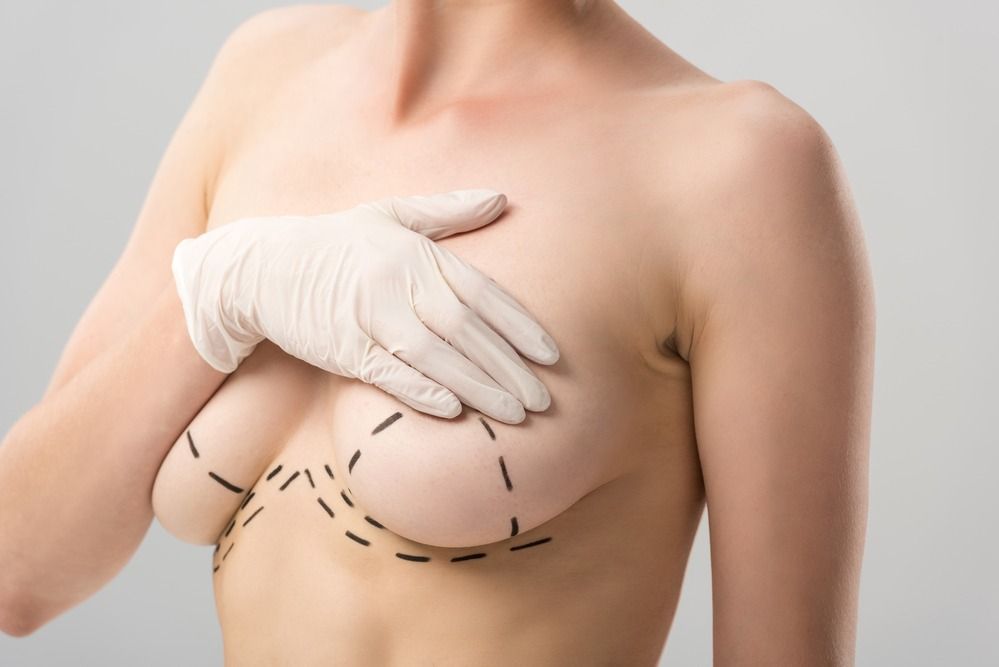  Breast Lift Surgery in Gurgaon