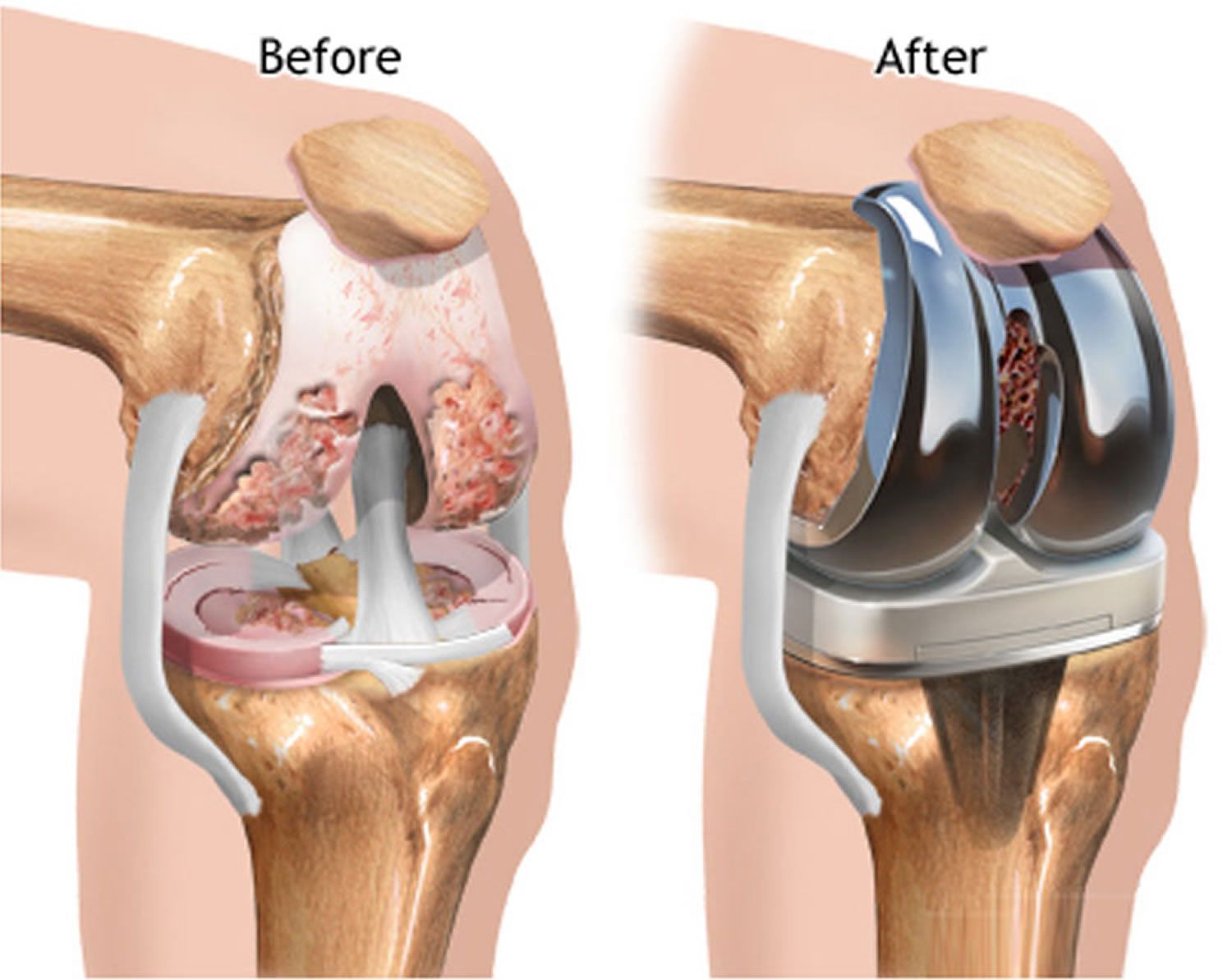 Knee Replacement Surgeon Delhi