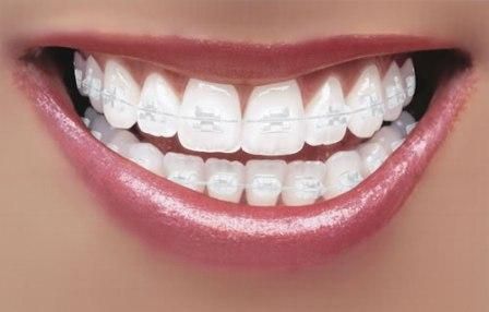 Porcelain Veneers Houston