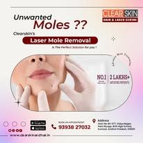Laser Treatment For Birthmark Removal In India