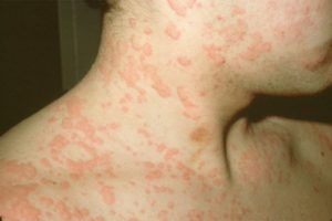 Best Doctor for urticaria in Delhi