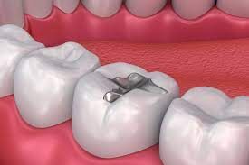 Emergency Tooth Filling Dentist Houston