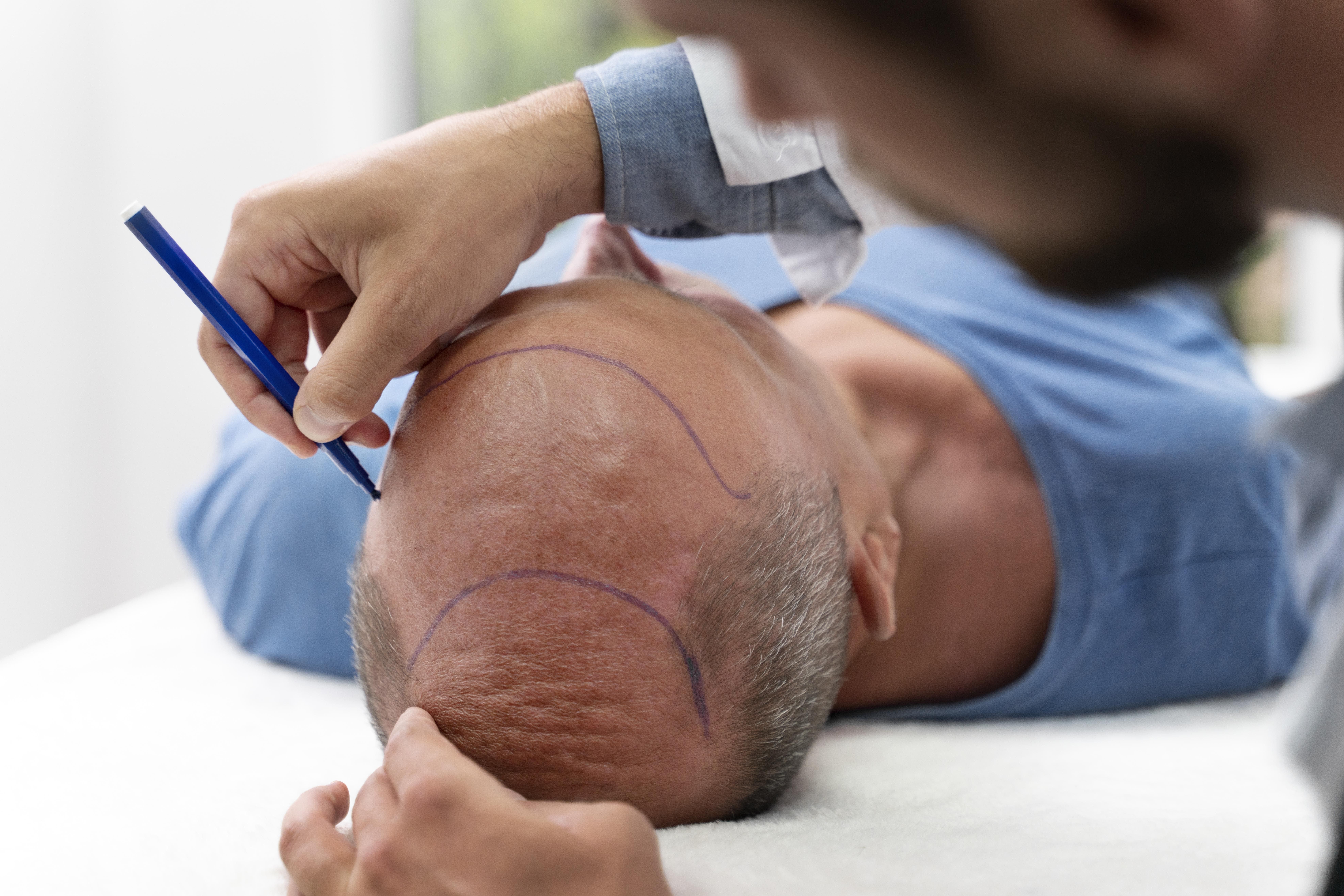 Get Natural Results at Affordable Hair Transplant Cost in Varanasi – Hair Aesthetica