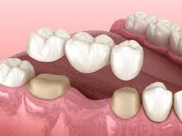 Periodontal Scaling And Root Planing