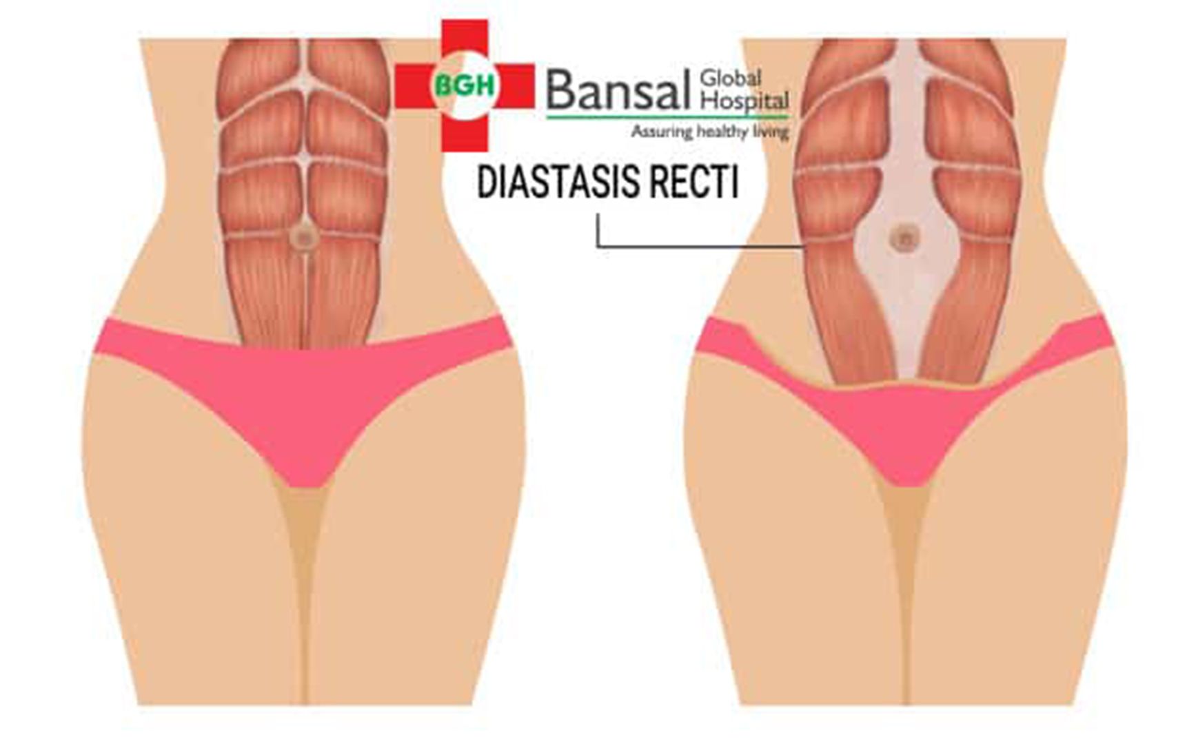 Diastasis Recti Treatment | Diastasis Recti Treatment in India