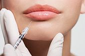 Lip Augmentation In London