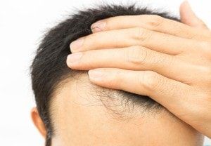 Cure Baldness with Hair loss Treatment in Delhi