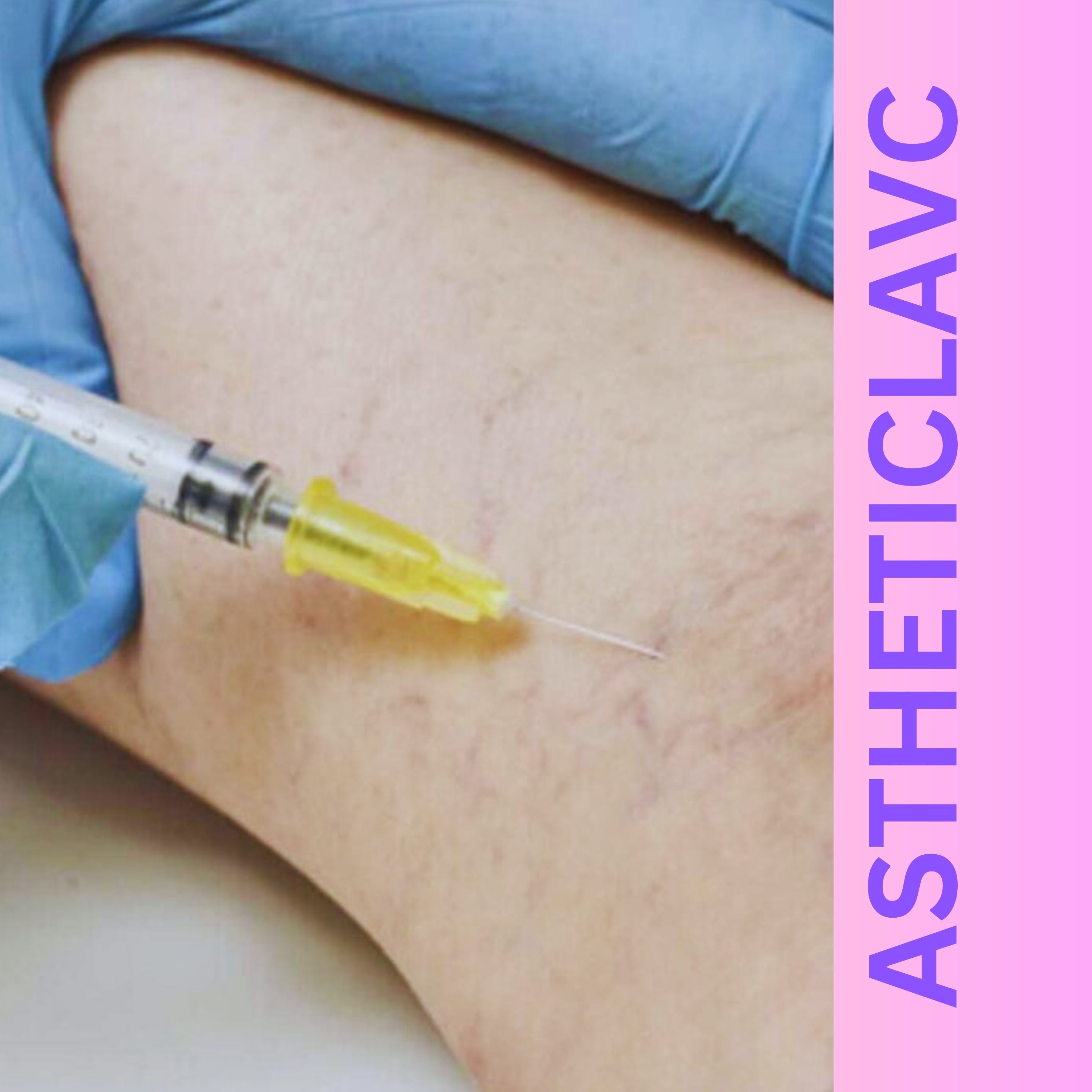 Effective Varicose Veins Treatment in Maryland at Aestheticlavc