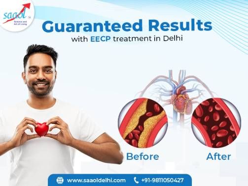 Guaranteed Result With EECP Treatment in Delhi