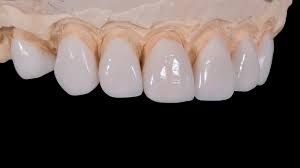 Porcelain Veneers Procedure